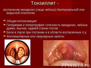 воспаление миндалин (чаще небных) бактериальной или вирусной этиологии воспалени