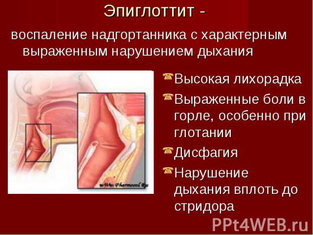 воспаление надгортанника с характерным выраженным нарушением дыхания воспаление надгортанника с характерным выраженным нарушением дыхания