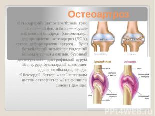 Остеоартроз Остеоартро з (лат.osteoarthrosis, грек. osleon&nbsp;— сүйек, arthron