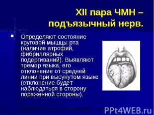XII пара ЧМН – подъязычный нерв. Определяют состояние круговой мышцы рта (наличи