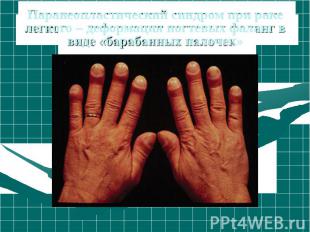 Паранеопластический синдром при раке легкого – деформация ногтевых фаланг в виде