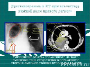 Рентгенограмма и КТ при ателектазе нижней доли правого легкого