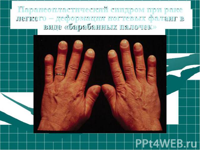 Паранеопластический синдром при раке легкого – деформация ногтевых фаланг в виде «барабанных палочек»