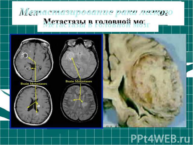Метастазирование рака легкого Метастазы в головной мозг