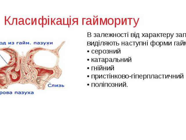 Класифікація гаймориту В залежності від характеру запалення виділяють наступні форми гаймориту: • серозний • катаральний • гнійний • пристінково-гіперпластичний • поліпозний.