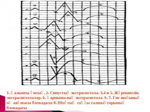 1. Қалыпты қисық. 2. Синустық экстрасистола. 3,4 и 5. Жүрекшелік экстрасистолала