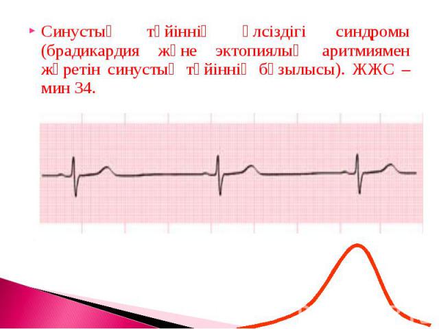 Синустық түйіннің әлсіздігі синдромы (брадикардия және эктопиялық аритмиямен жүретін синустық түйіннің бұзылысы). ЖЖС – мин 34.Синустық түйіннің әлсіздігі синдромы (брадикардия және эктопиялық аритмиямен жүретін синустық түйіннің бұзылысы). ЖЖС – мин 34.