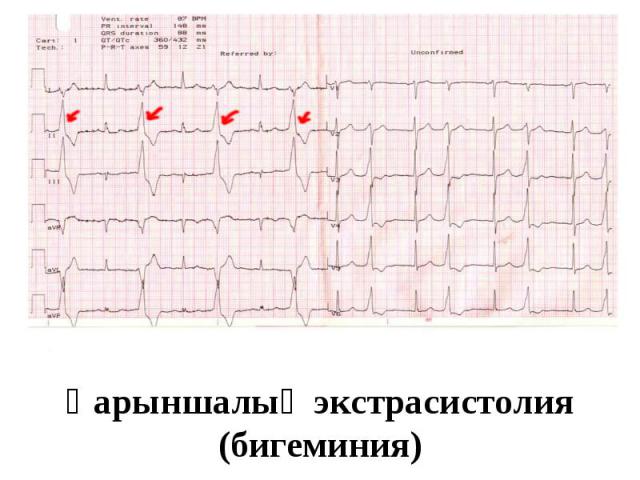 Қарыншалық экстрасистолия (бигеминия)