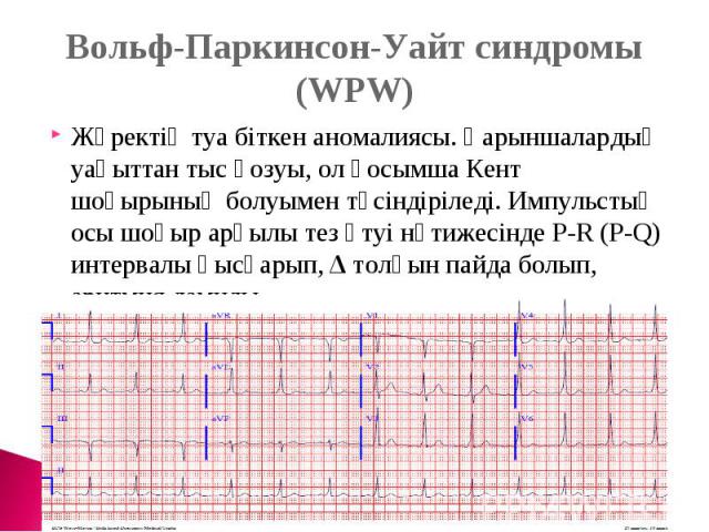 Вольф-Паркинсон-Уайт синдромы (WPW)Жүректің туа біткен аномалиясы. Қарыншалардың уақыттан тыс қозуы, ол қосымша Кент шоғырының болуымен түсіндіріледі. Импульстың осы шоғыр арқылы тез өтуі нәтижесінде P-R (P-Q) интервалы қысқарып, Δ толқын пайда болы…