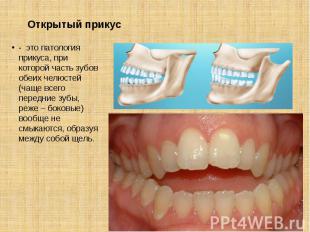 Открытый прикус - это патология прикуса, при которой часть зубов обеих челюстей