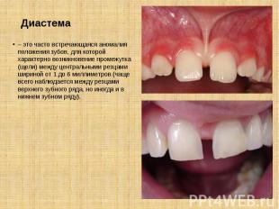 Диастема – это часто встречающаяся аномалия положения зубов, для которой характе