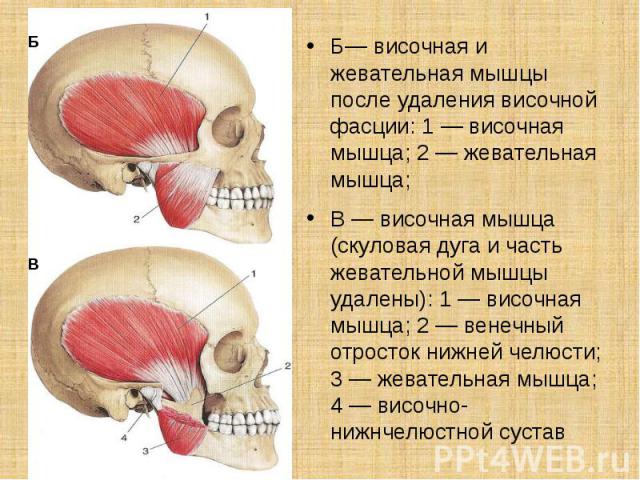 . Б— височная и жевательная мышцы после удаления височной фасции: 1 — височная мышца; 2 — жевательная мышца; В — височная мышца (скуловая дуга и часть жевательной мышцы удалены): 1 — височная мышца; 2 — венечный отросток нижней челюсти; 3 — жеватель…