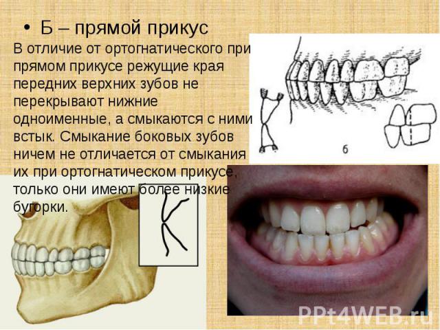 . Б – прямой прикус