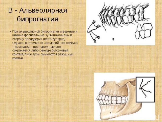 В - Альвеолярная бипрогнатия При альвеолярной бипрогнатии и верхние и нижние фронтальные зубы наклонены в сторону преддверия (вестибулярно). Однако, в отличие от аномалийного прикуса – прогнатии – при таком наклоне сохраняется либо режуще бугорковый…