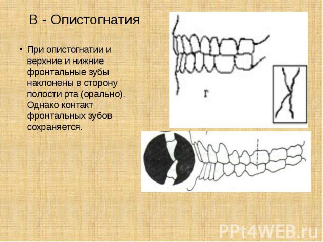 В - Опистогнатия При опистогнатии и верхние и нижние фронтальные зубы наклонены в сторону полости рта (орально). Однако контакт фронтальных зубов сохраняется.