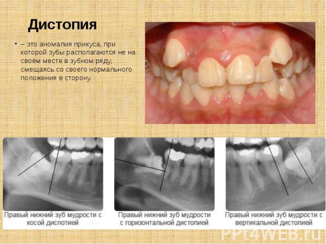 Дистопия – это аномалия прикуса, при которой зубы располагаются не на своём месте в зубном ряду, смещаясь со своего нормального положения в сторону.