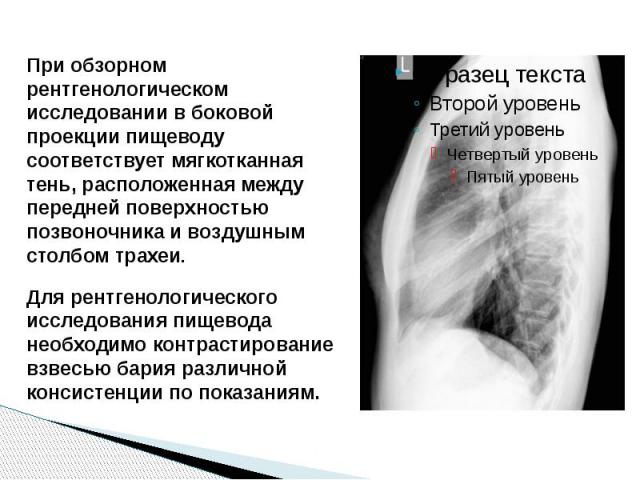 При обзорном рентгенологическом исследовании в боковой проекции пищеводу соответствует мягкотканная тень, расположенная между передней поверхностью позвоночника и воздушным столбом трахеи. Для рентгенологического исследования пищевода необходимо кон…