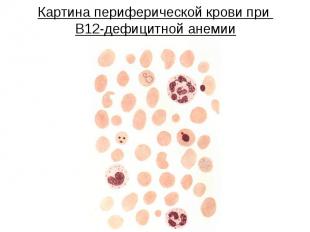 Картина периферической крови при В12-дефицитной анемии