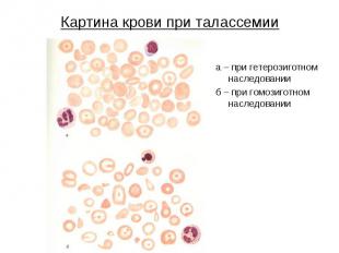 Картина крови при талассемии