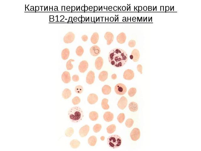 Картина периферической крови при В12-дефицитной анемии