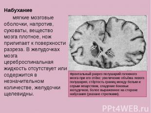 Набухание Набухание мягкие мозговые оболочки, напротив, суховаты, вещество мозга
