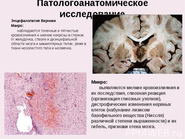 Патологоанатомическое исследование Энцефалопатия Вернике Макро: наблюдаются точечные и пятнистые кровоизлияния и мелкие некрозы в стенках III желудочка, стволе и диэнцефальной области мозга и мамиллярных телах, реже в ткани мозолистого тела и мозжечка.