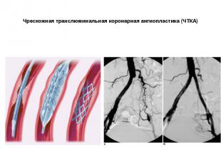 Чрескожная транслюминальная коронарная ангиопластика (ЧТКА)