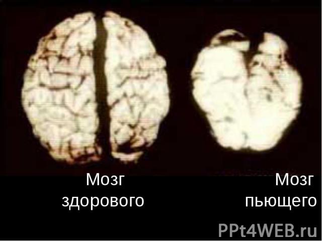 Мозг Мозг здорового пьющего