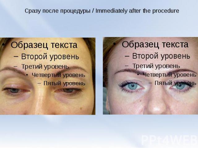 Сразу после процедуры / Immediately after the procedure