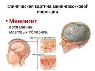 Клиническая картина менингококковой инфекции Менингит воспаление мозговых оболоч