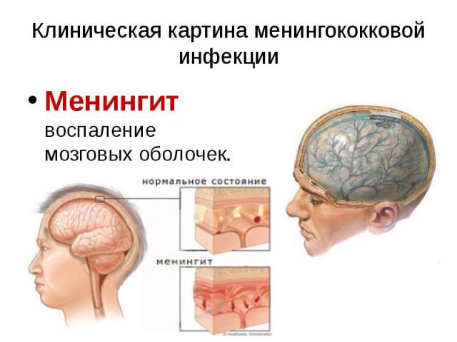 Клиническая картина менингококковой инфекции Менингит воспаление мозговых оболочек.
