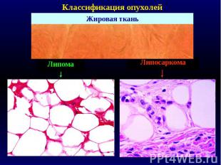 Классификация опухолей Жировая ткань