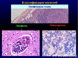 Классификация опухолей Лимфоидная ткань