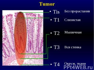 Tumor Tis