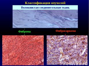 Классификация опухолей Волокнистая соединительная ткань