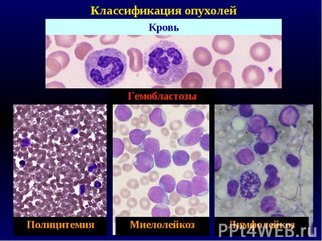 Классификация опухолей Кровь