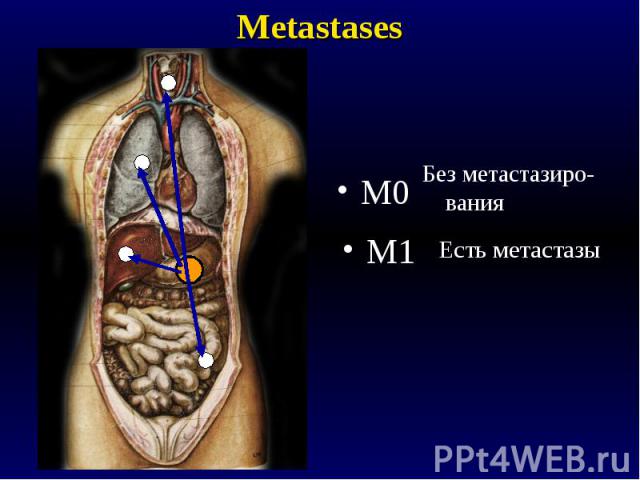 Metastases M0