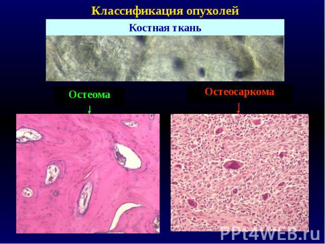 Классификация опухолей Костная ткань