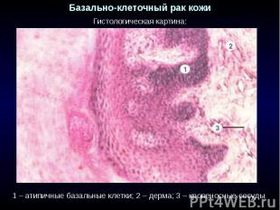 Базально-клеточный рак кожи Гистологическая картина: