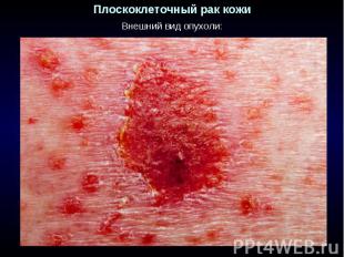 Плоскоклеточный рак кожи Внешний вид опухоли: