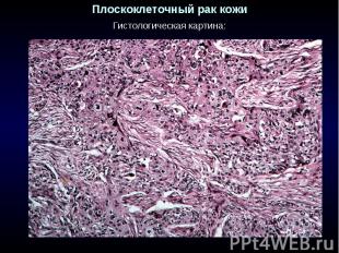Плоскоклеточный рак кожи Гистологическая картина: