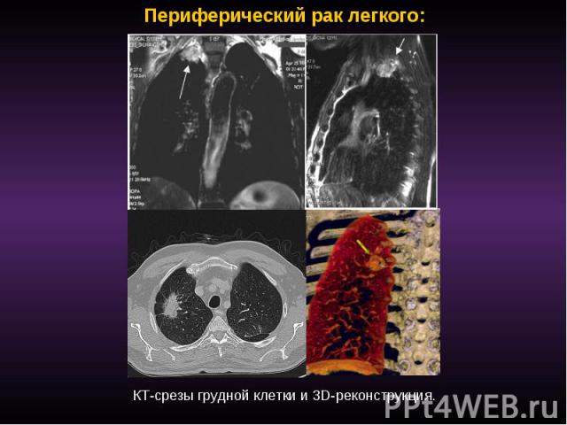 Периферический рак легкого: КТ-срезы грудной клетки и 3D-реконструкция.