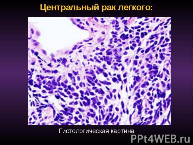 Центральный рак легкого: Гистологическая картина