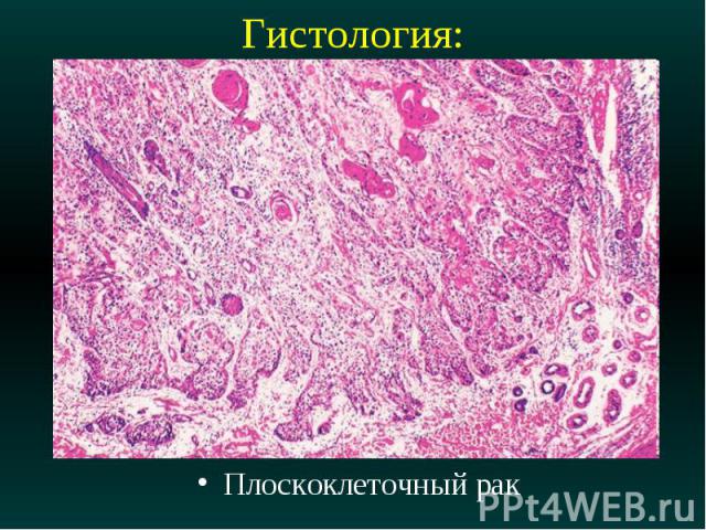 Гистология: Плоскоклеточный рак