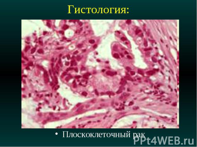 Гистология: Плоскоклеточный рак