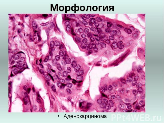Морфология Аденокарцинома