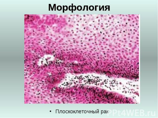 Морфология Плоскоклеточный рак