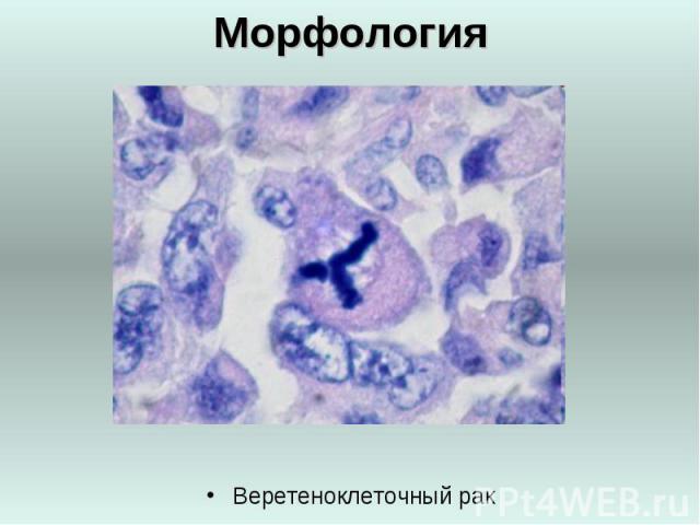 Морфология Веретеноклеточный рак