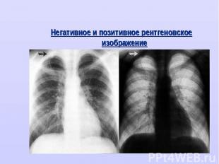 Негативное и позитивное рентгеновское изображение Негативное и позитивное рентге