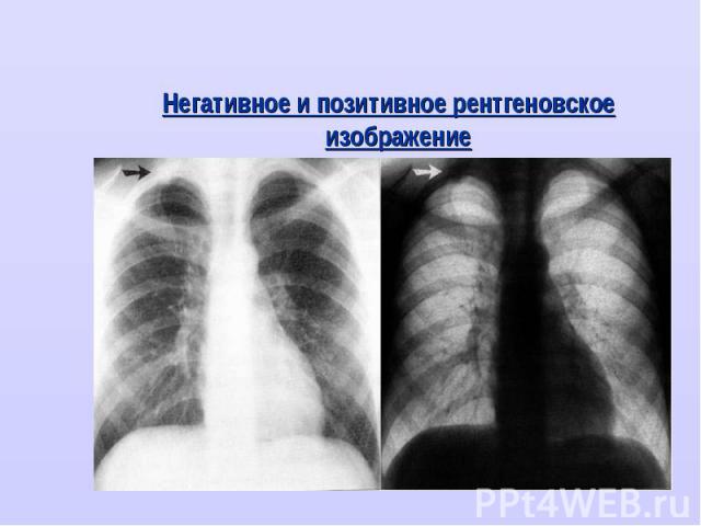 Негативное и позитивное рентгеновское изображение Негативное и позитивное рентгеновское изображение